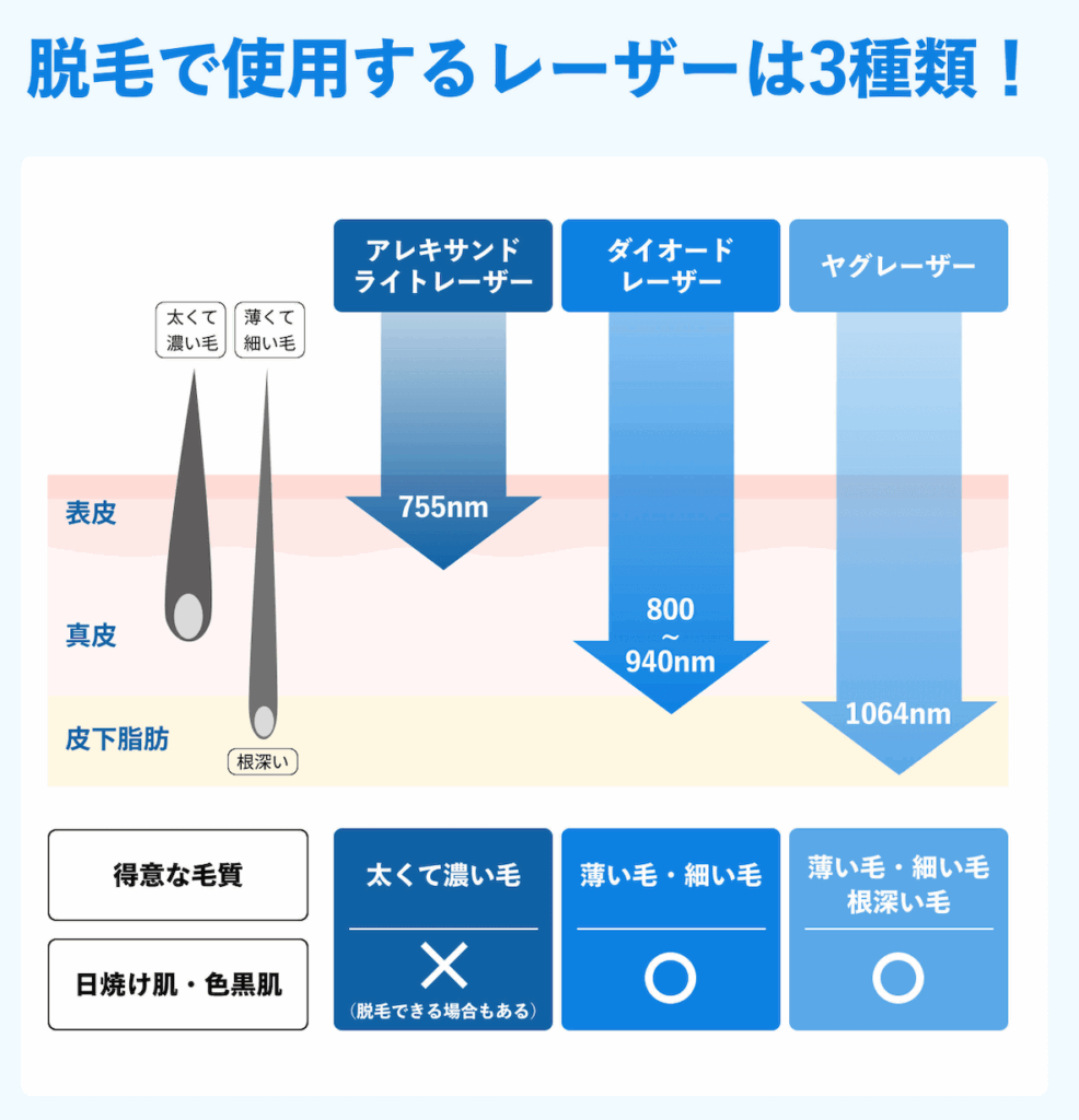 メンズ脱毛_レーザーの種類