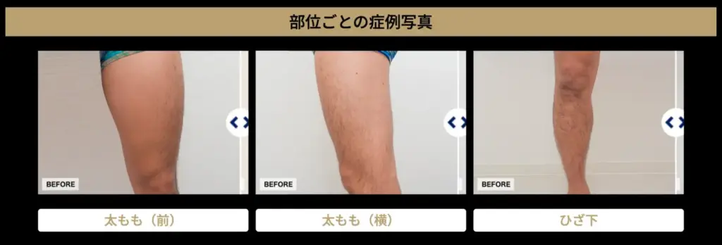ゴリラ脚脱毛症例