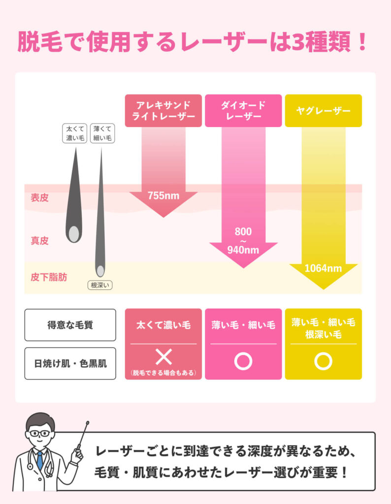 レーザーの種類